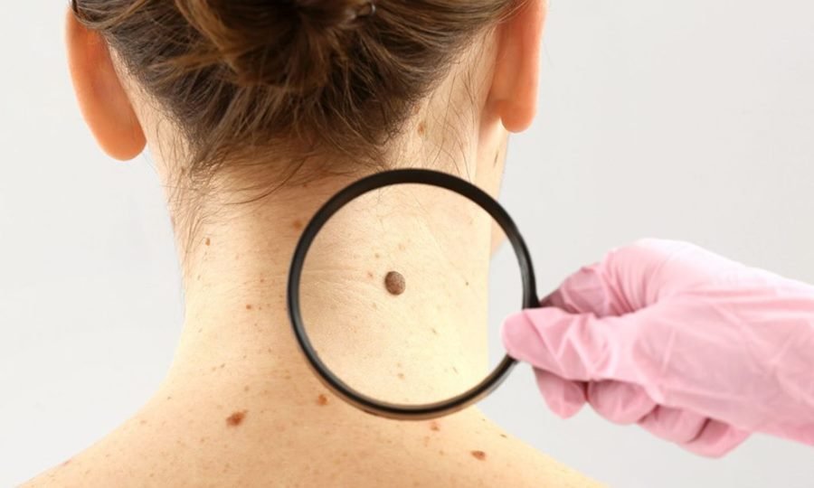 Se realizarán chequeos de gratuitos de lunares en la Estación Belgrano