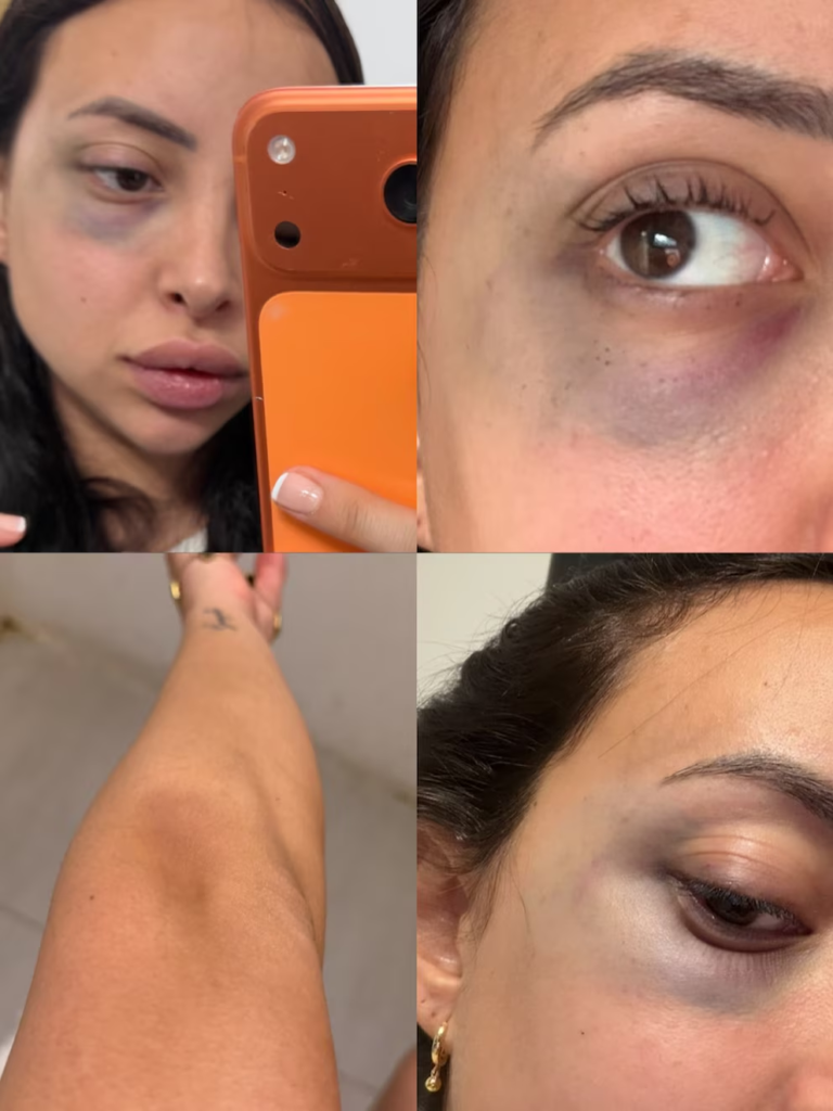 Karen Dinna, la ex pareja de Gonzalo Morales, mostró cómo le quedó el rostro tras acusar por violencia de género al futbolista de Barracas Central